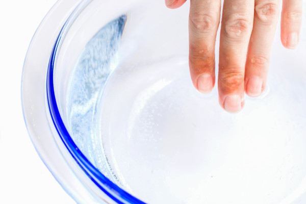 Woman puts her scalded hand into cold water